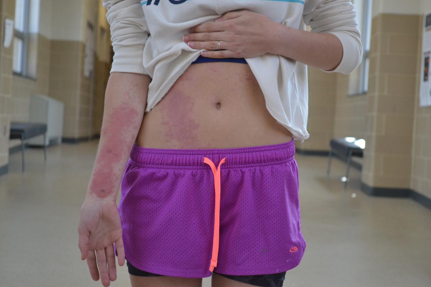 Grace Ebacher-Rini suffers from  her first poison ivy reaction. Ebacher-Rini was not able to sleep because of the severity of the poison ivy.